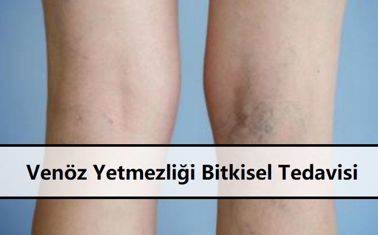 Venöz Yetmezliği Bitkisel Tedavisi